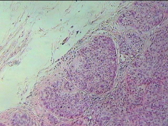 角结膜鳞状上皮细胞癌一例