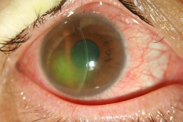   荧光素染色显示着色区（绿色）为角膜上皮糜烂