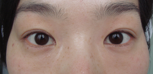 术后1年，双眼对称，重睑弧度自然。
