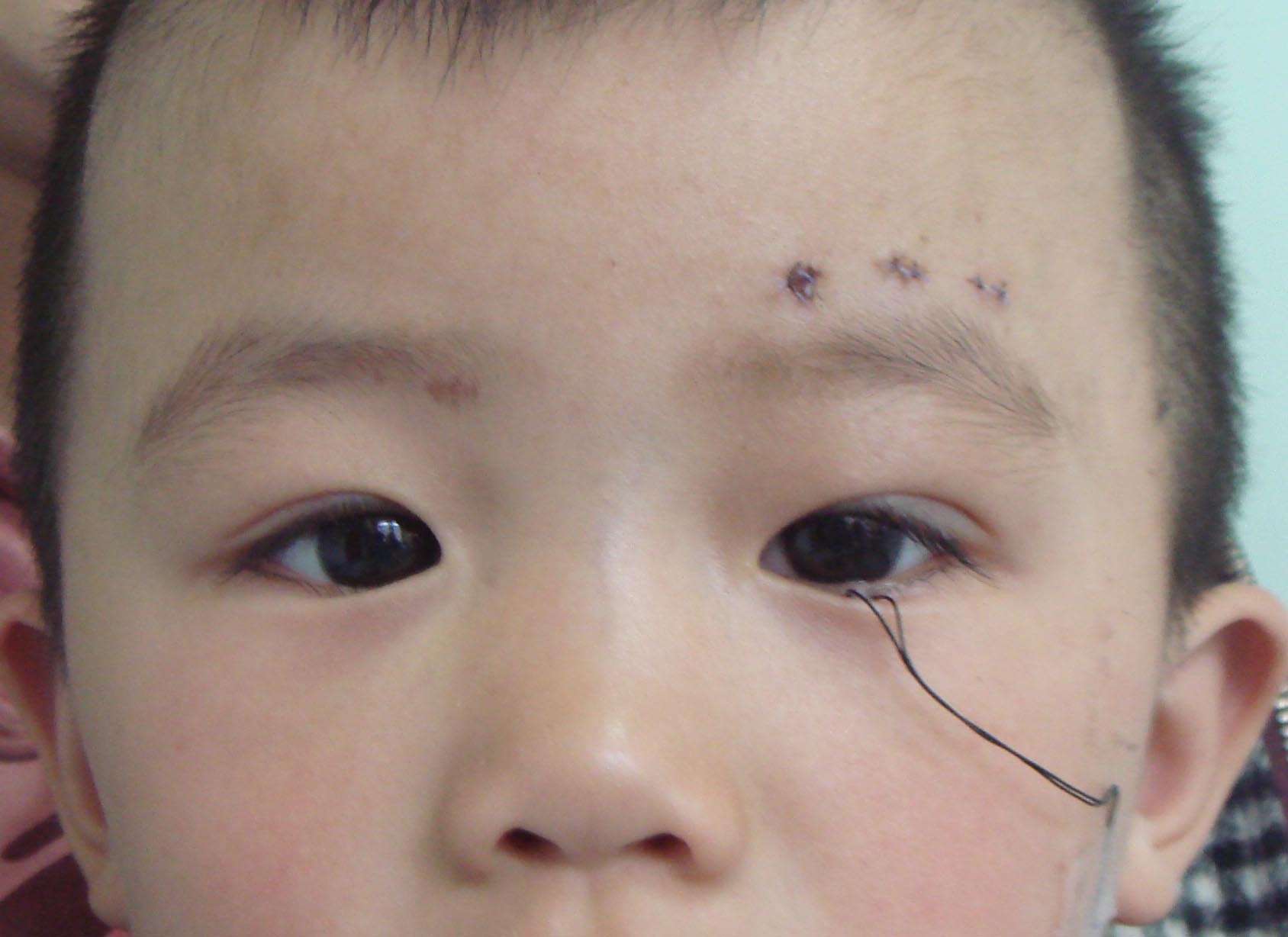 先天性眼瞼下垂・生後6ヶ月からの視力検査 | 下垂っ子ママの育児日記