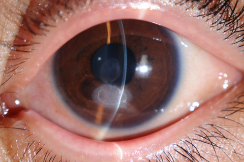 医師はどのようにして VK を診断するのでしょうか?